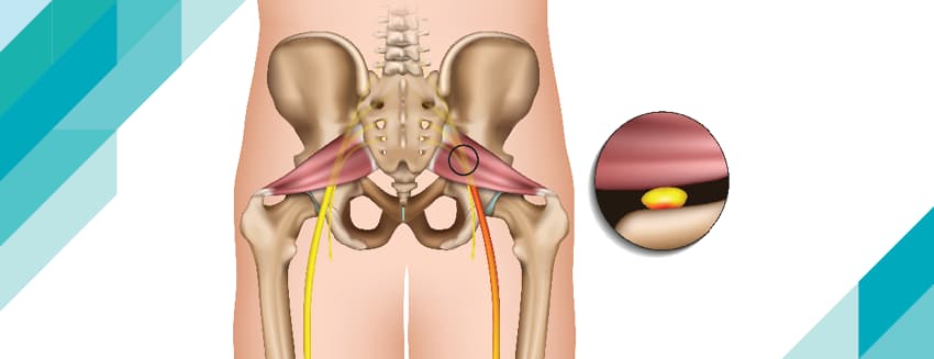 Priformis sendromu