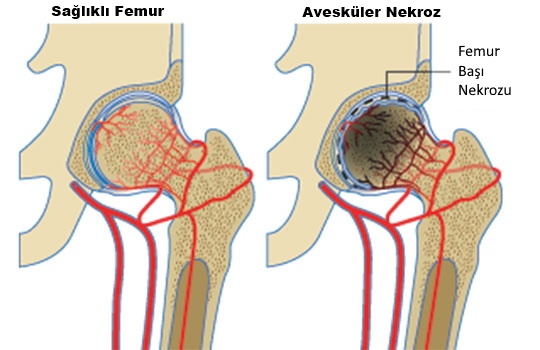 Avaskuler nekroz