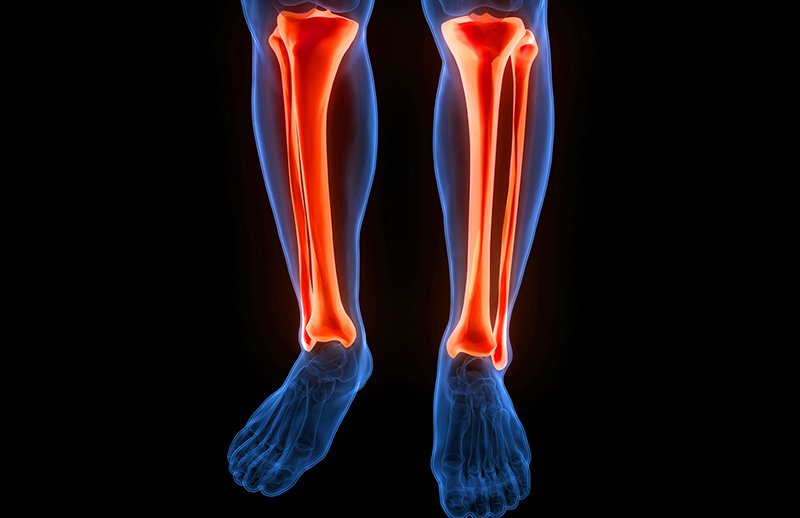 Yüksek Tibial Osteotomi